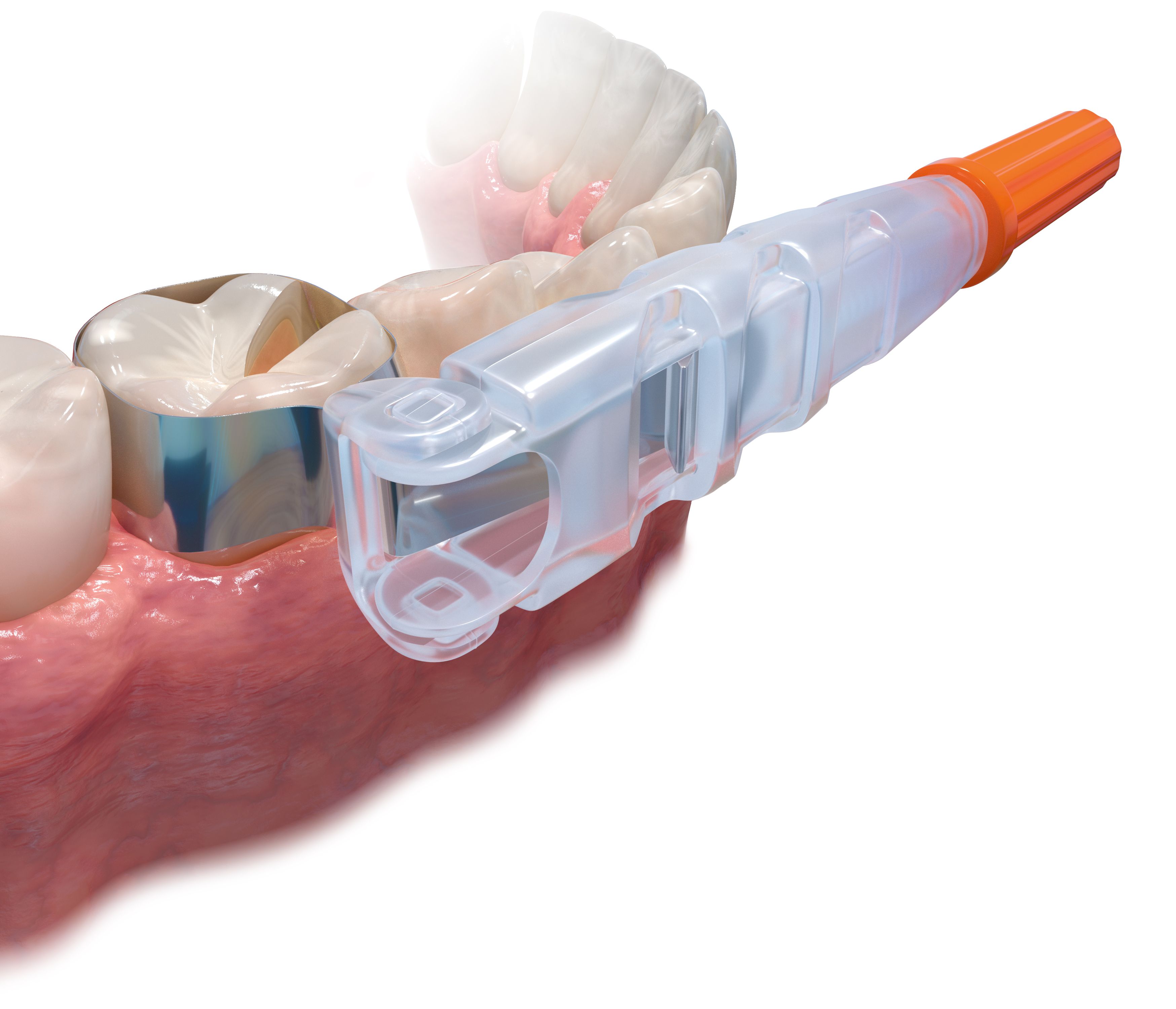 Omni-Matrix-Disposable-Retainer-and-Matrix.jpg
